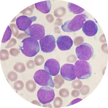 Subtype classification model for leukemia
